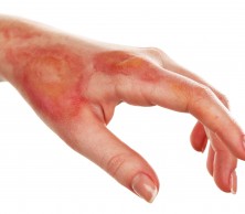A female hands showing sign of a burn or scold.